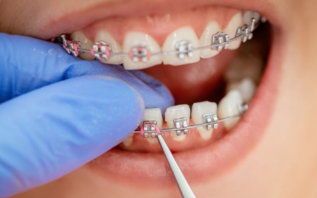Keeping Your Smile Fresh: Hygiene Tips with Braces
