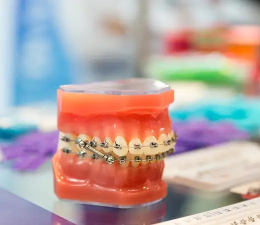 How to Eat with Braces Without Breaking a Bracket?