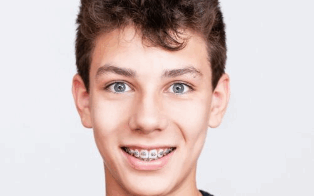 Braces Care: How to Prevent Plaque Around Your Ceramic Braces
