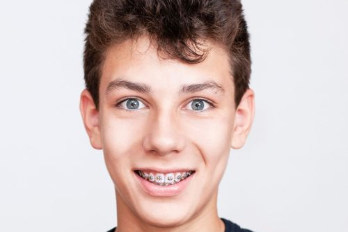 ceramic braces pearl