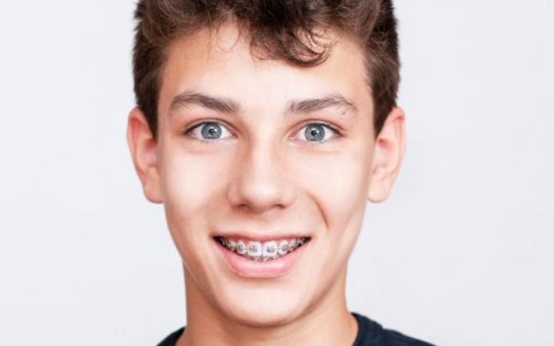 How Do You Take Care of Ceramic Braces?