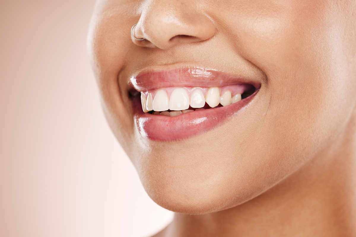 The Role of Cosmetic Restorations in Complete Smile Makeovers