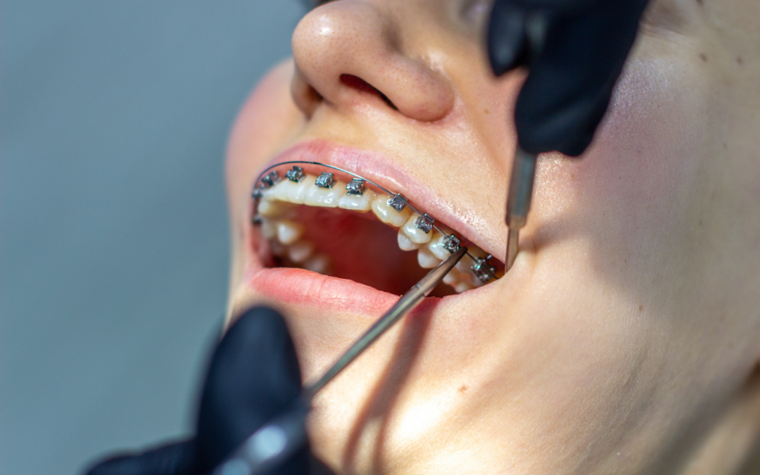 How to Adjust to Life with Braces: Tips for a Smooth Transition