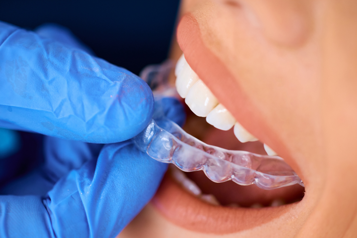 So Many Teens Are Choosing Invisalign