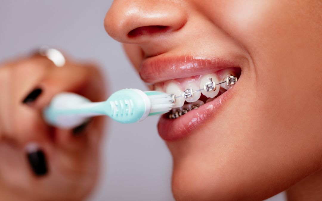 How to Brush With Braces Without Missing the Spots That Matter Most