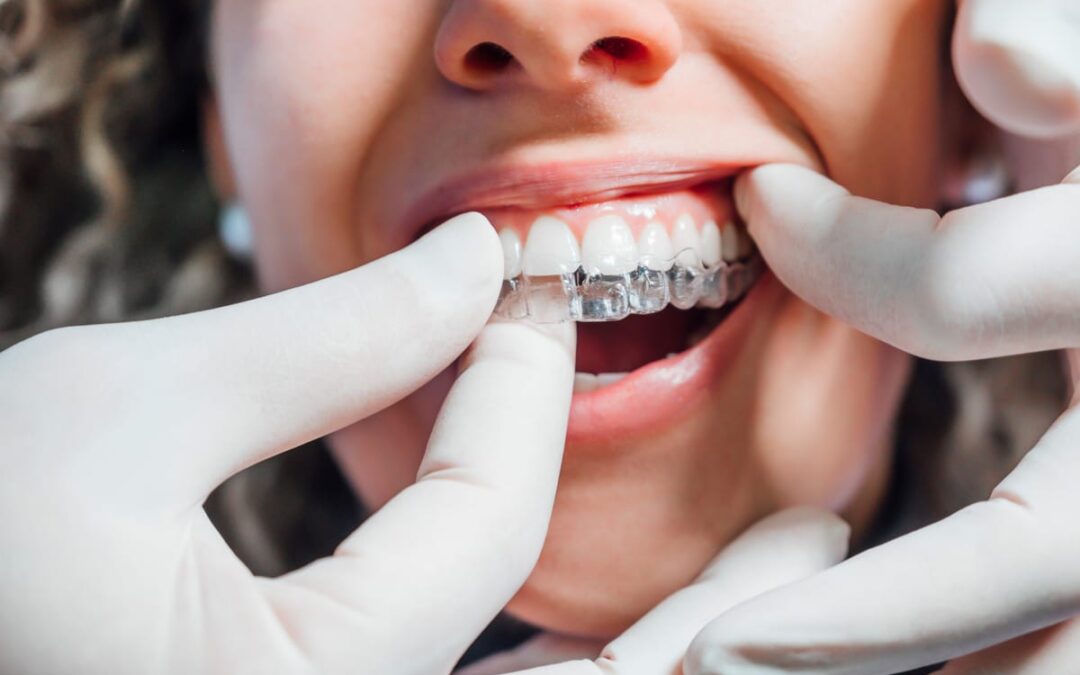 Invisalign Works for Some Smiles—But Not All