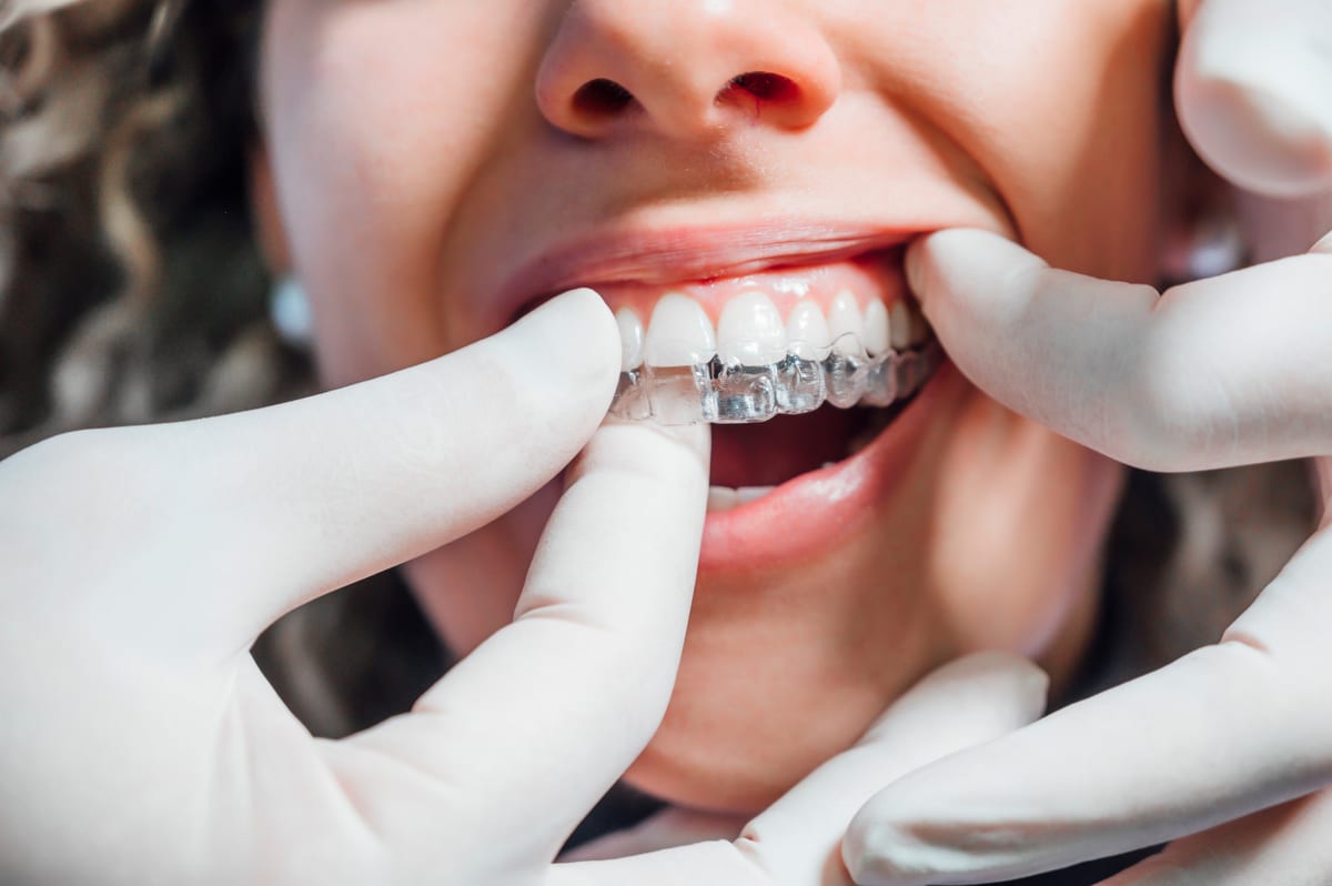 Invisalign in Pearl Invisalign in Pearl
